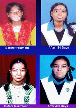 DRDO Lab. finds cure for Leucoderma